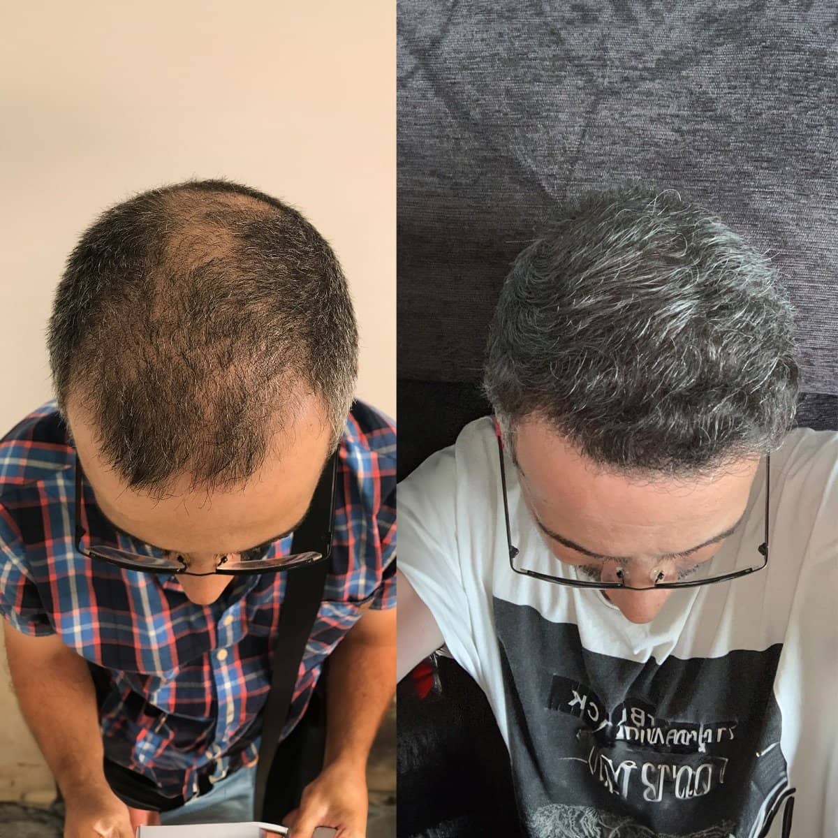Case 16025 - hair transplant