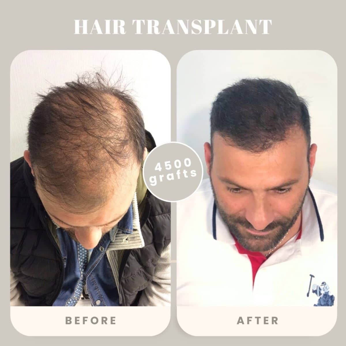 Case 16026 - hair transplant