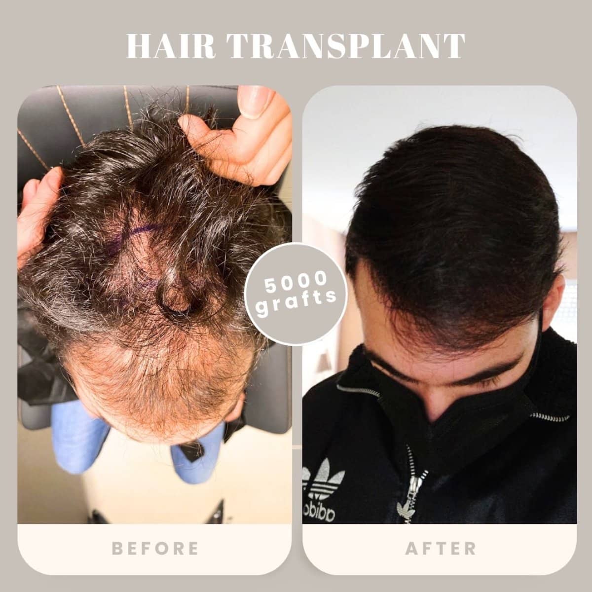 Case 16027 - hair transplant