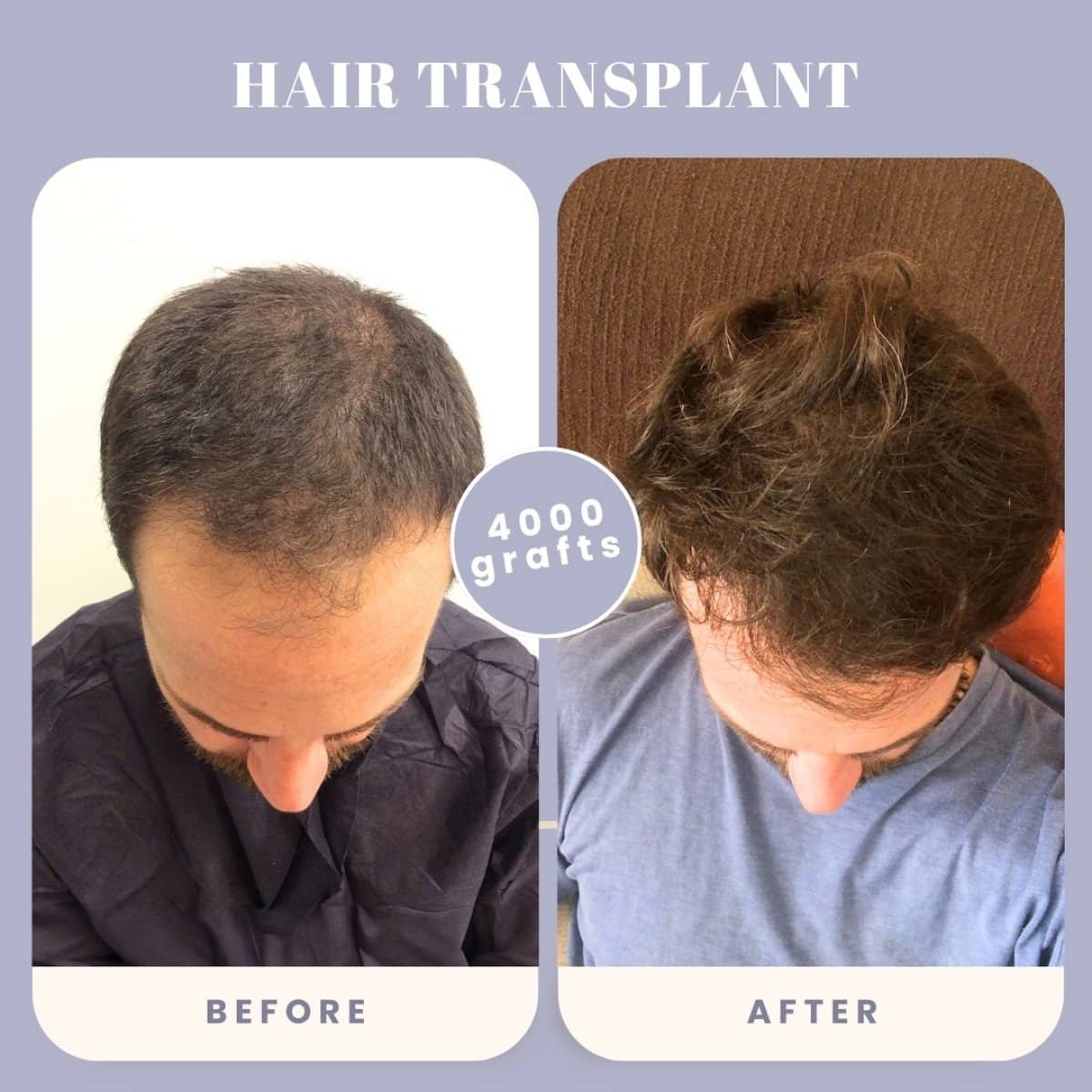 Case 16028 - hair transplant