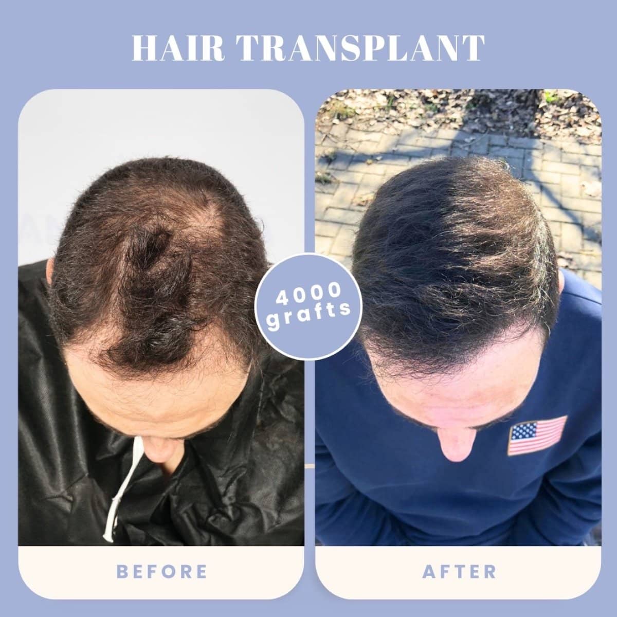 Case 16029 - hair transplant