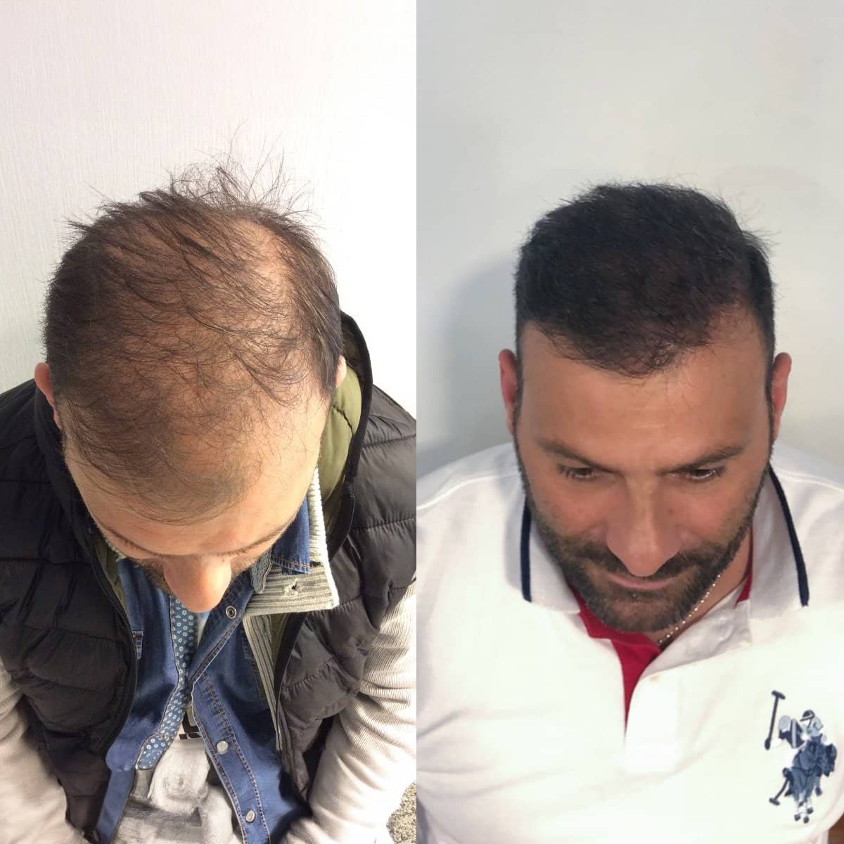 Case 16030 - hair transplant