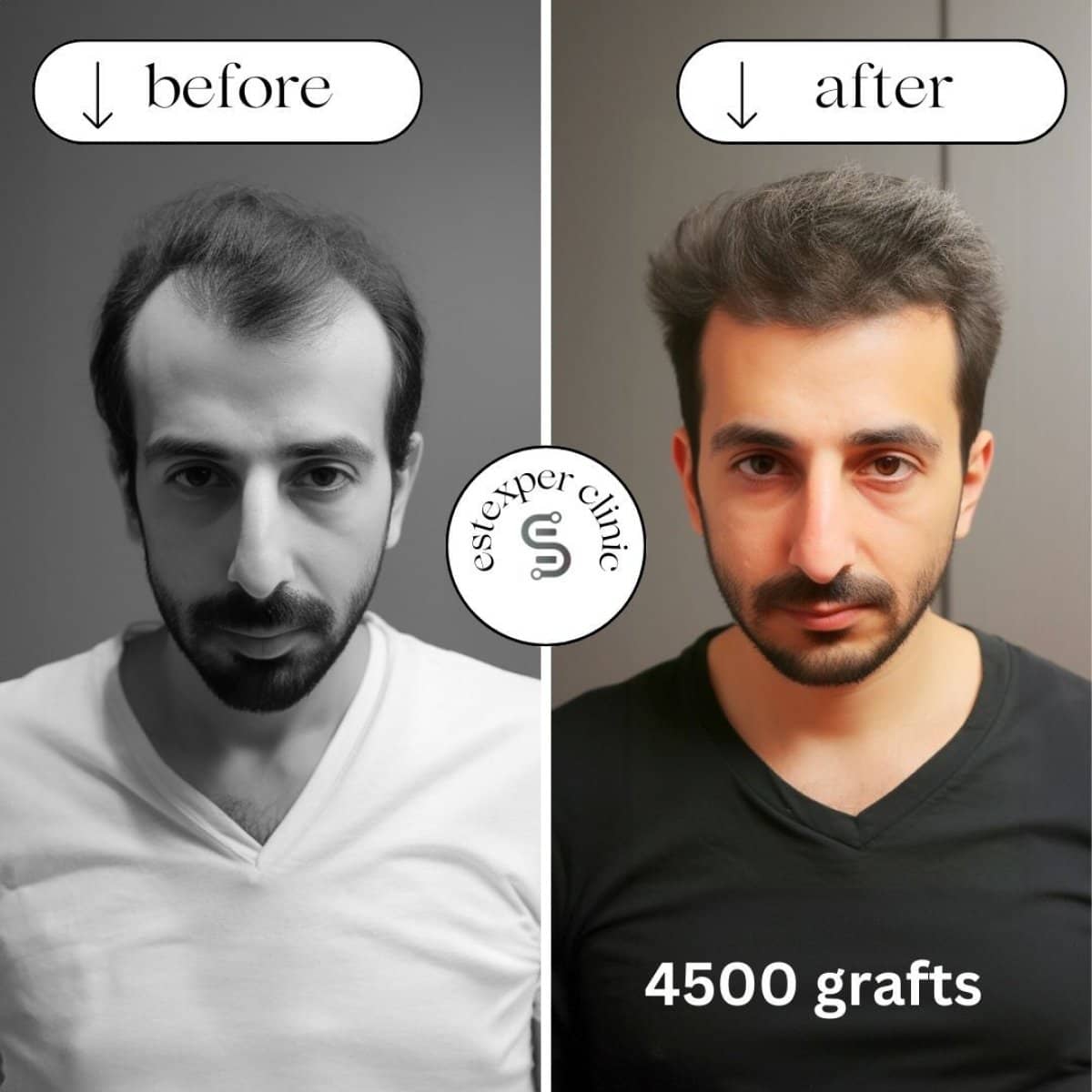 Case 16031 - hair transplant
