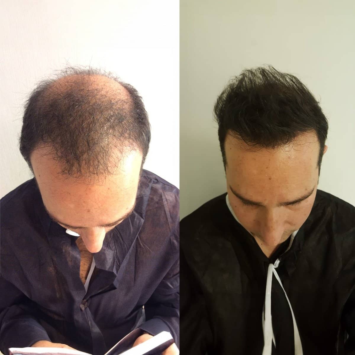 Case 16032 - hair transplant