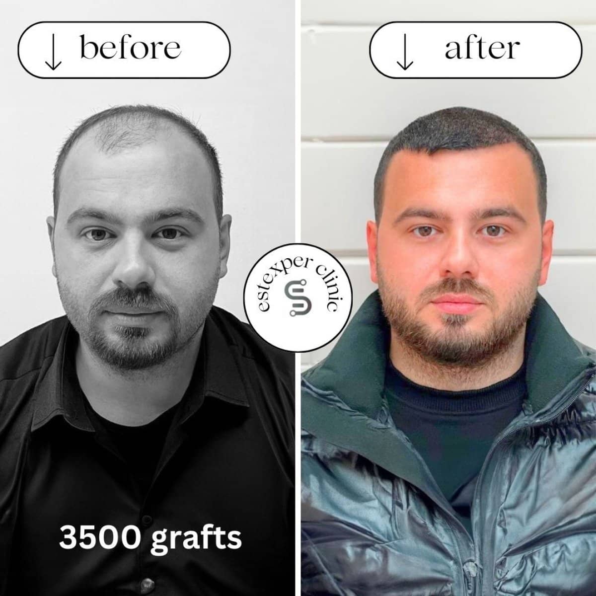 Case 16033 - hair transplant