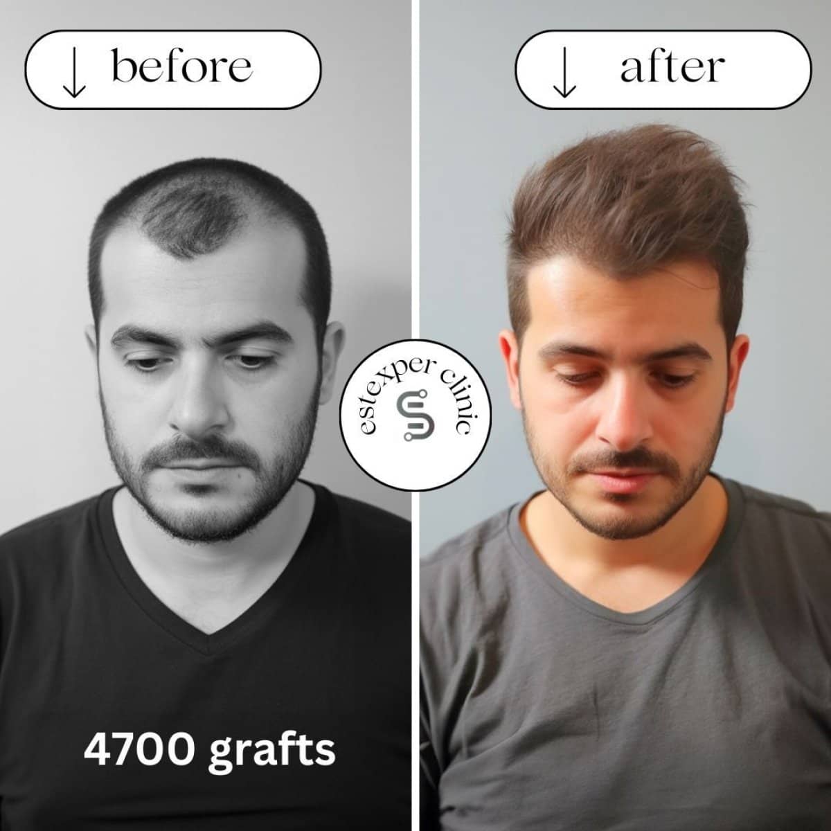 Case 16034 - hair transplant