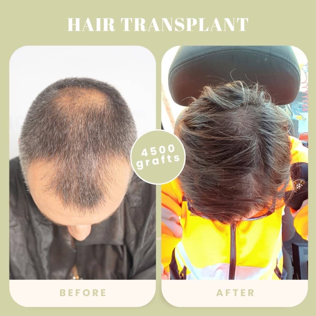 Case 16036 - hair transplant