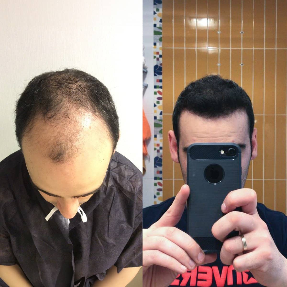 Case 16038 - hair transplant
