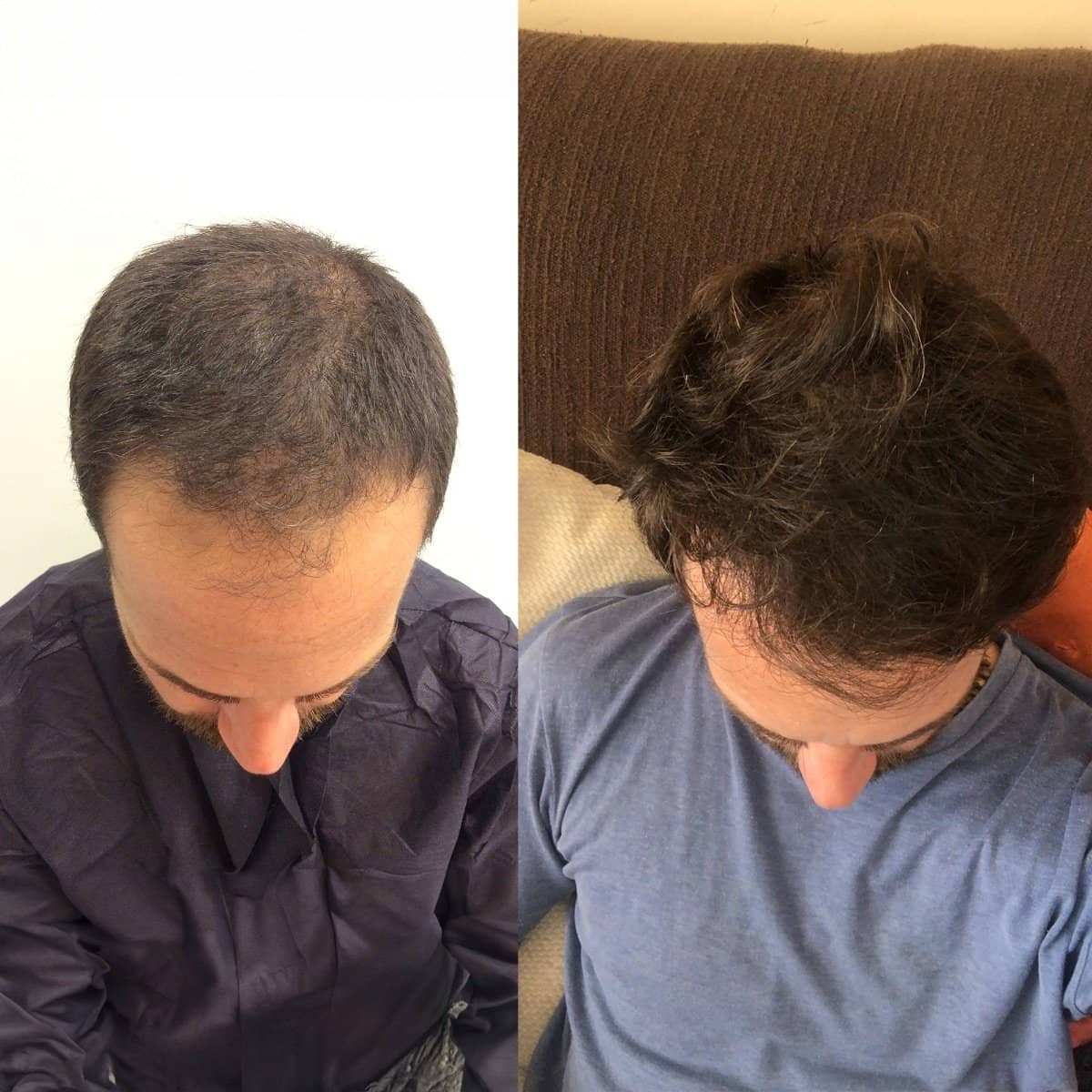Case 16039 - hair transplant