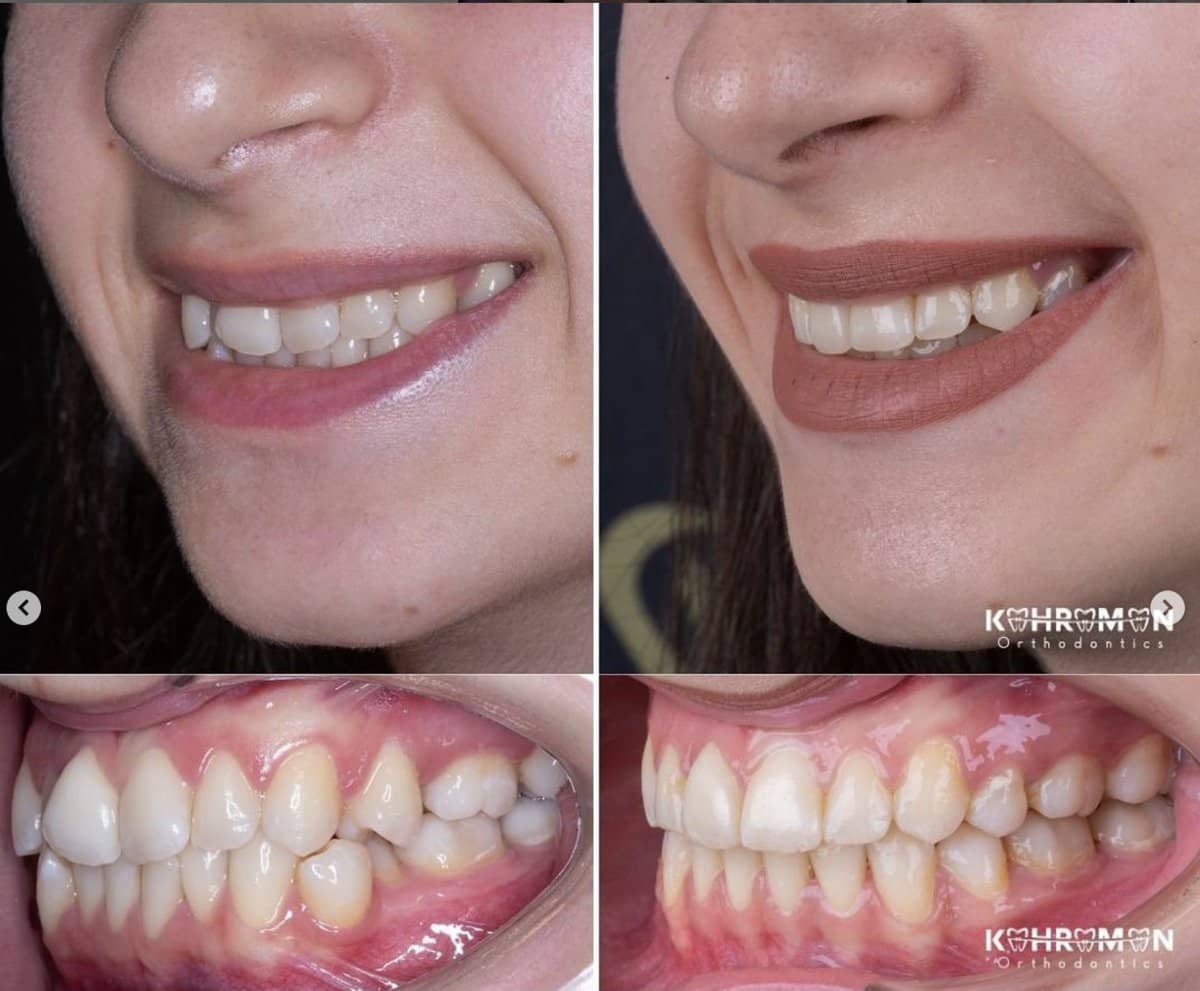 Case 16042 - Invisalign