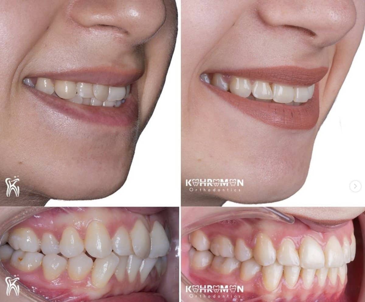Case 16043 - Invisalign