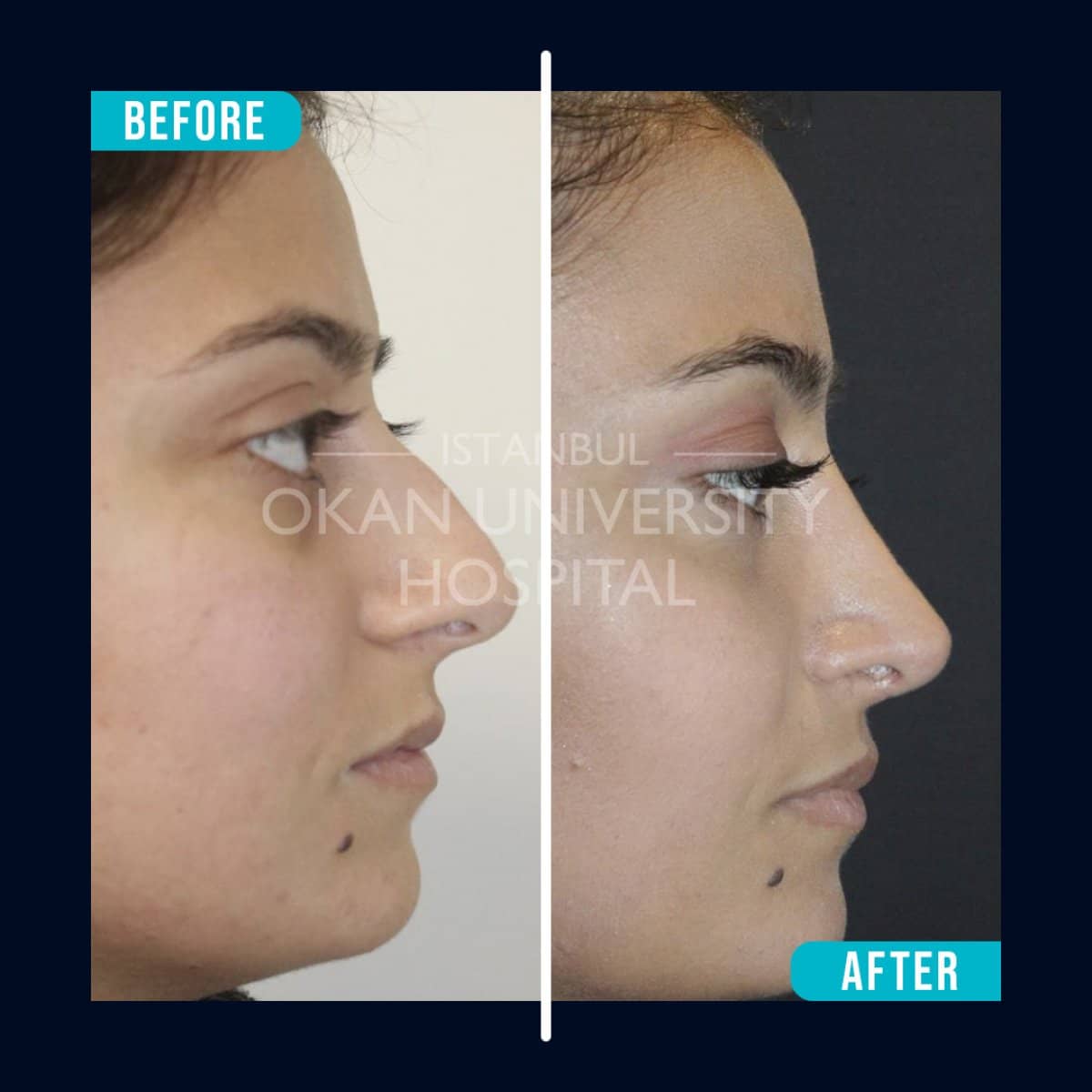 Case 16044 - rhinoplasty