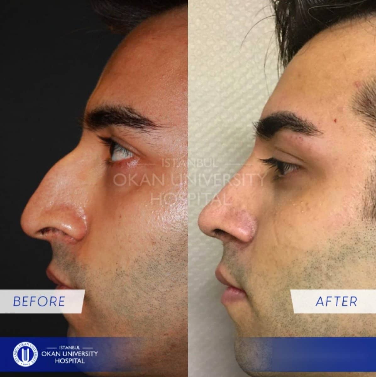 Case 16046 - rhinoplasty