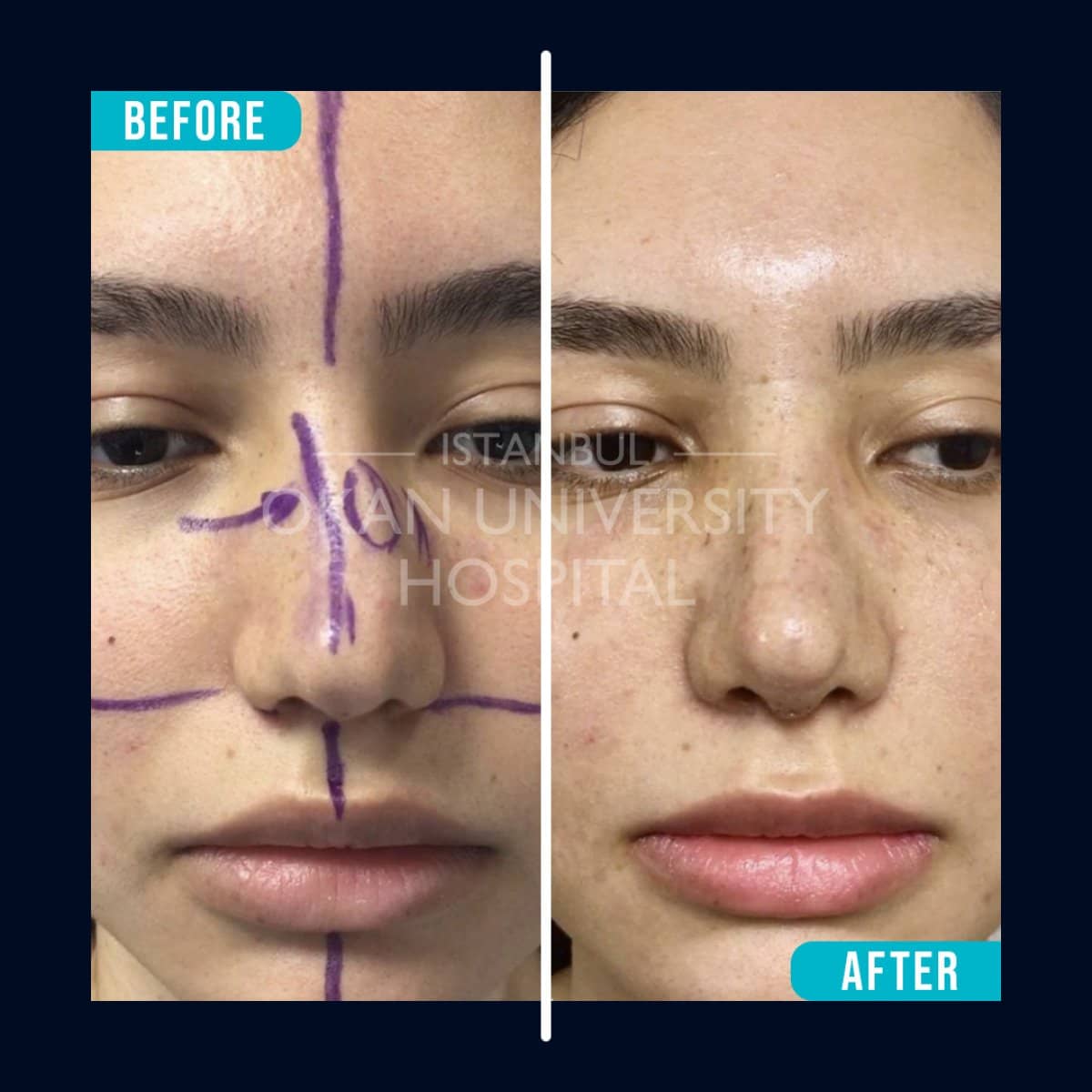 Case 16047 - rhinoplasty