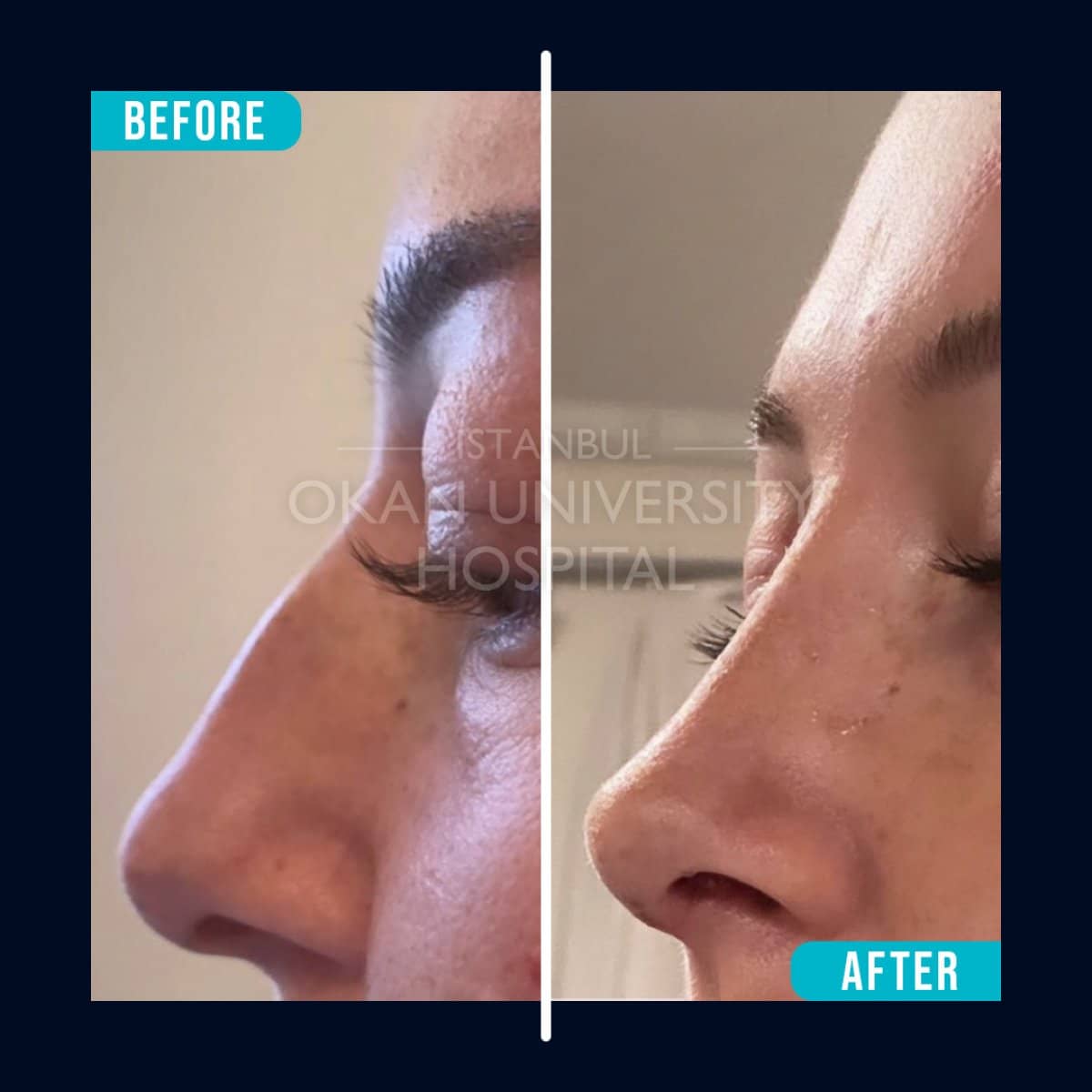 Case 16049 - rhinoplasty