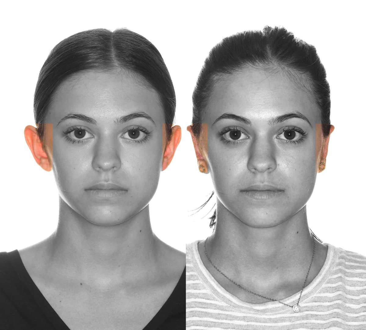 Case 16083 - otoplasty
