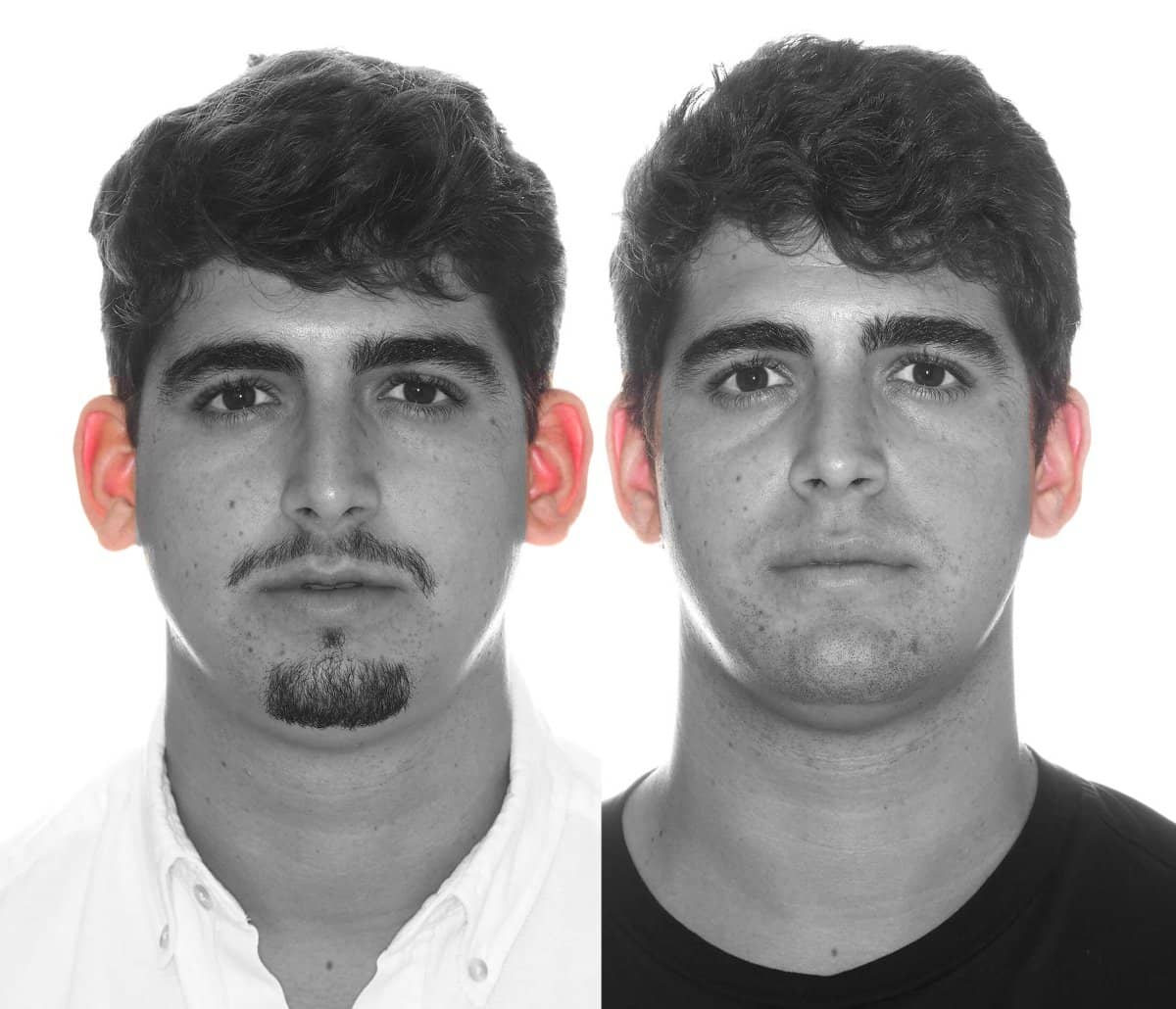 Case 16084 - otoplasty