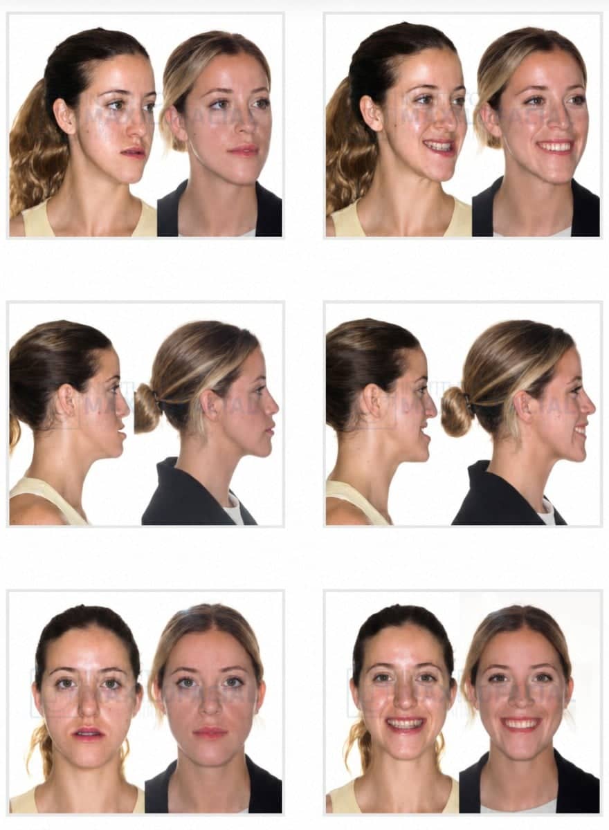 Case 16085 - orthognathic surgery