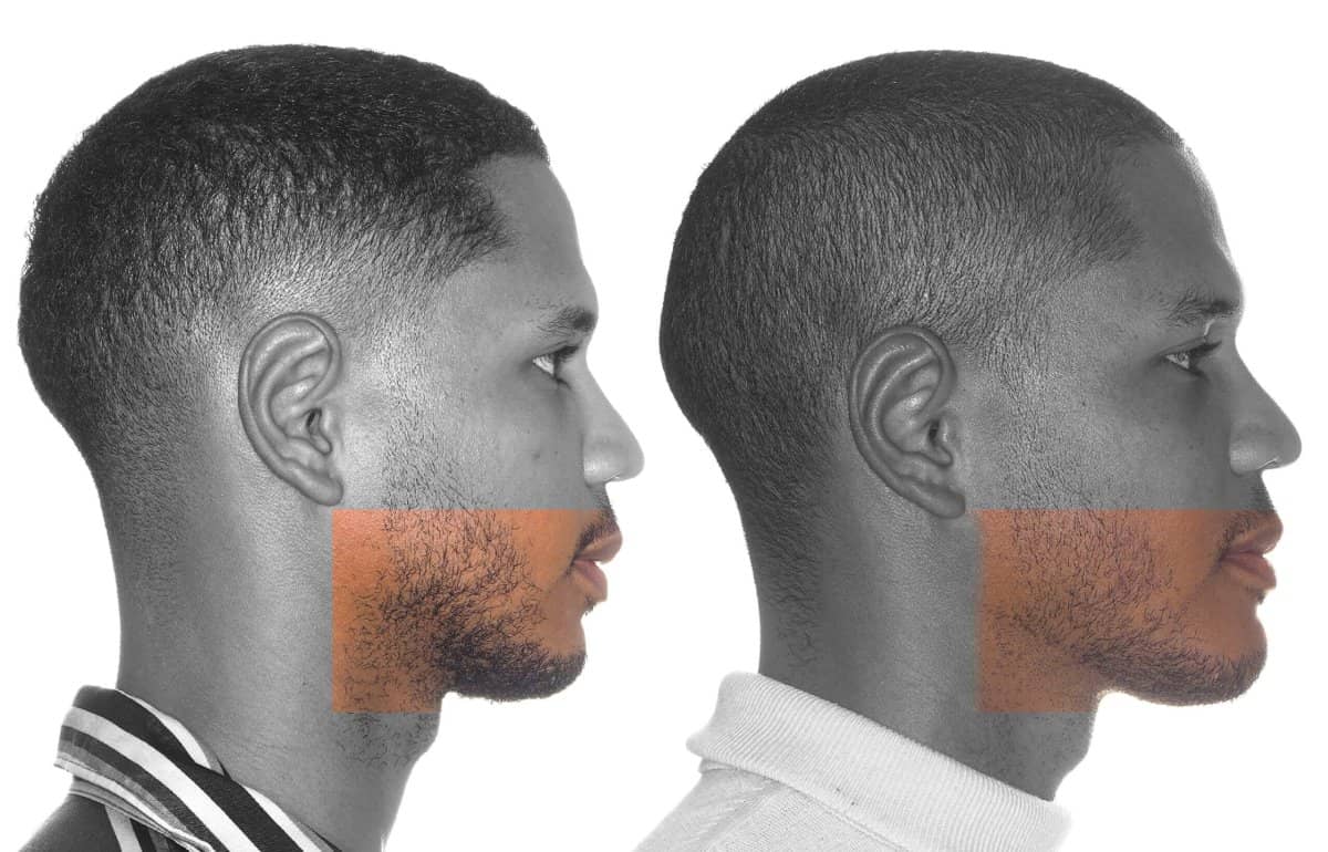 Case 16087 - chin implant