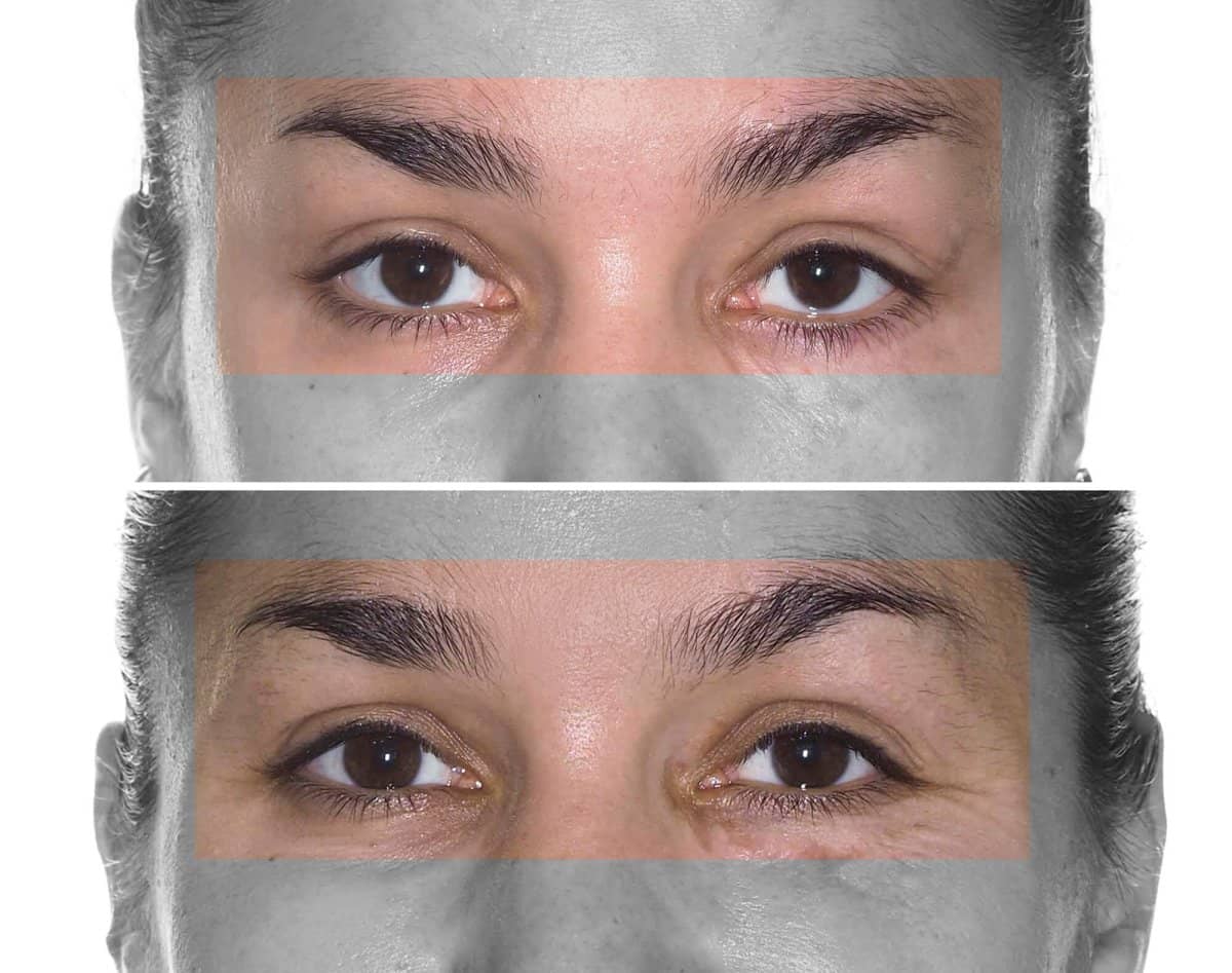 Case 16088 - blepharoplasty