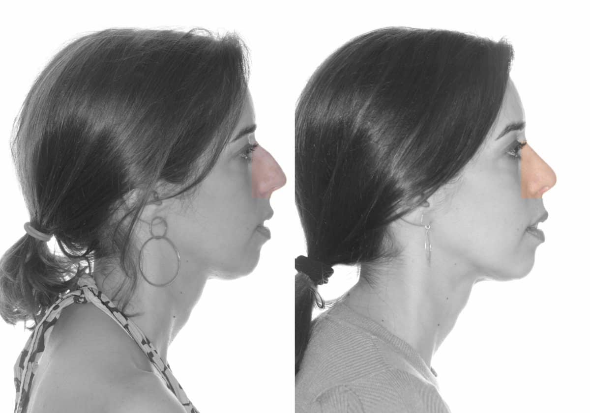 Case 16090 - rhinoplasty