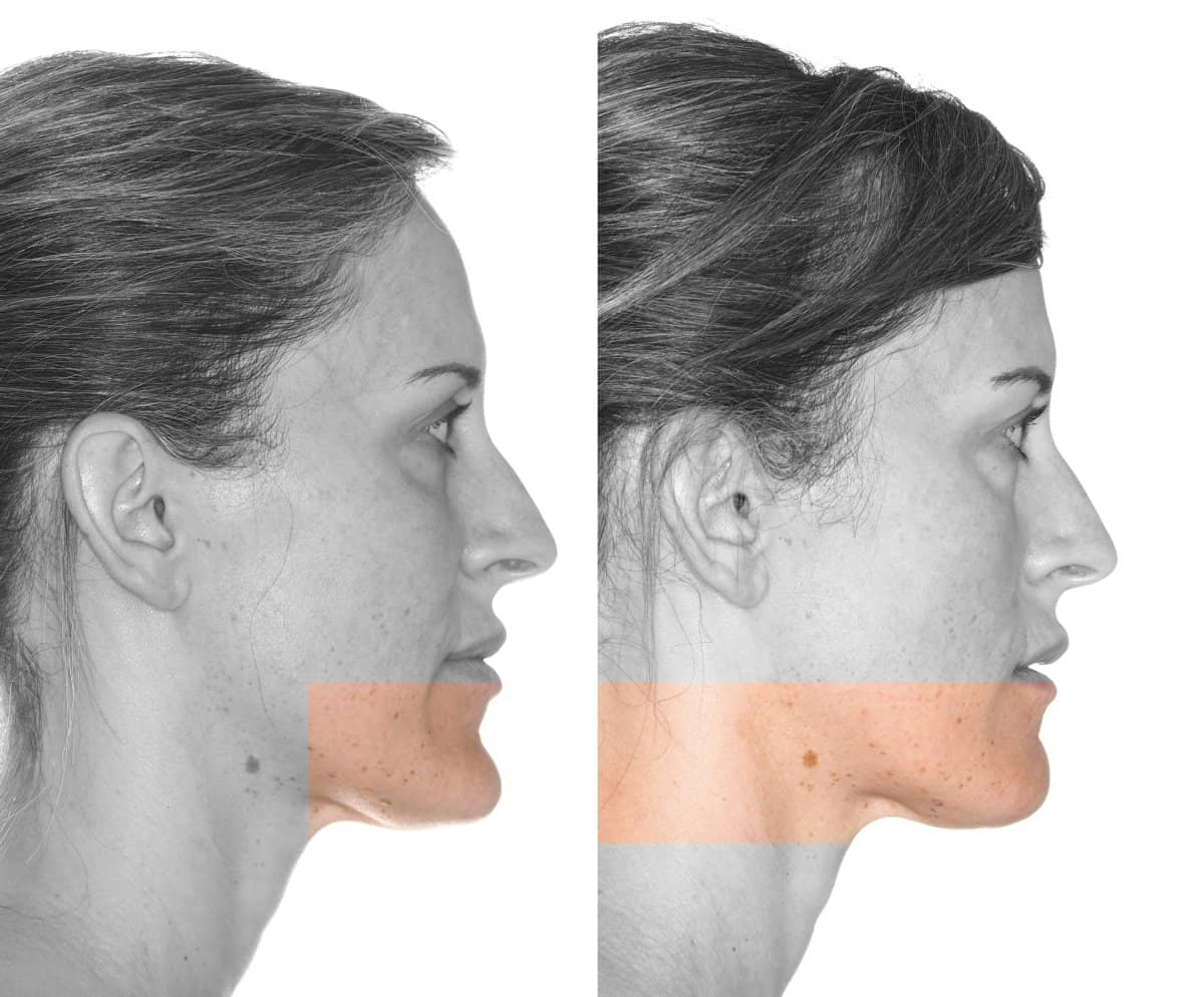 Case 16091 - chin implant