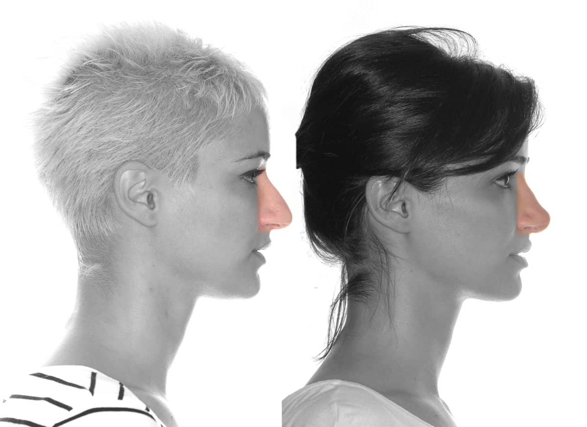 Case 16092 - rhinoplasty