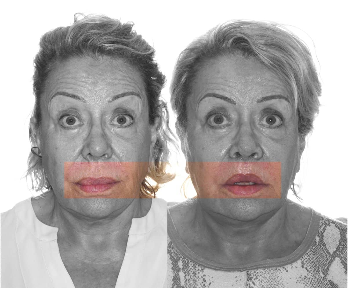 Case 16094 - lip lift