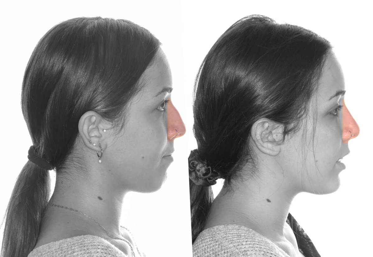 Case 16095 - rhinoplasty