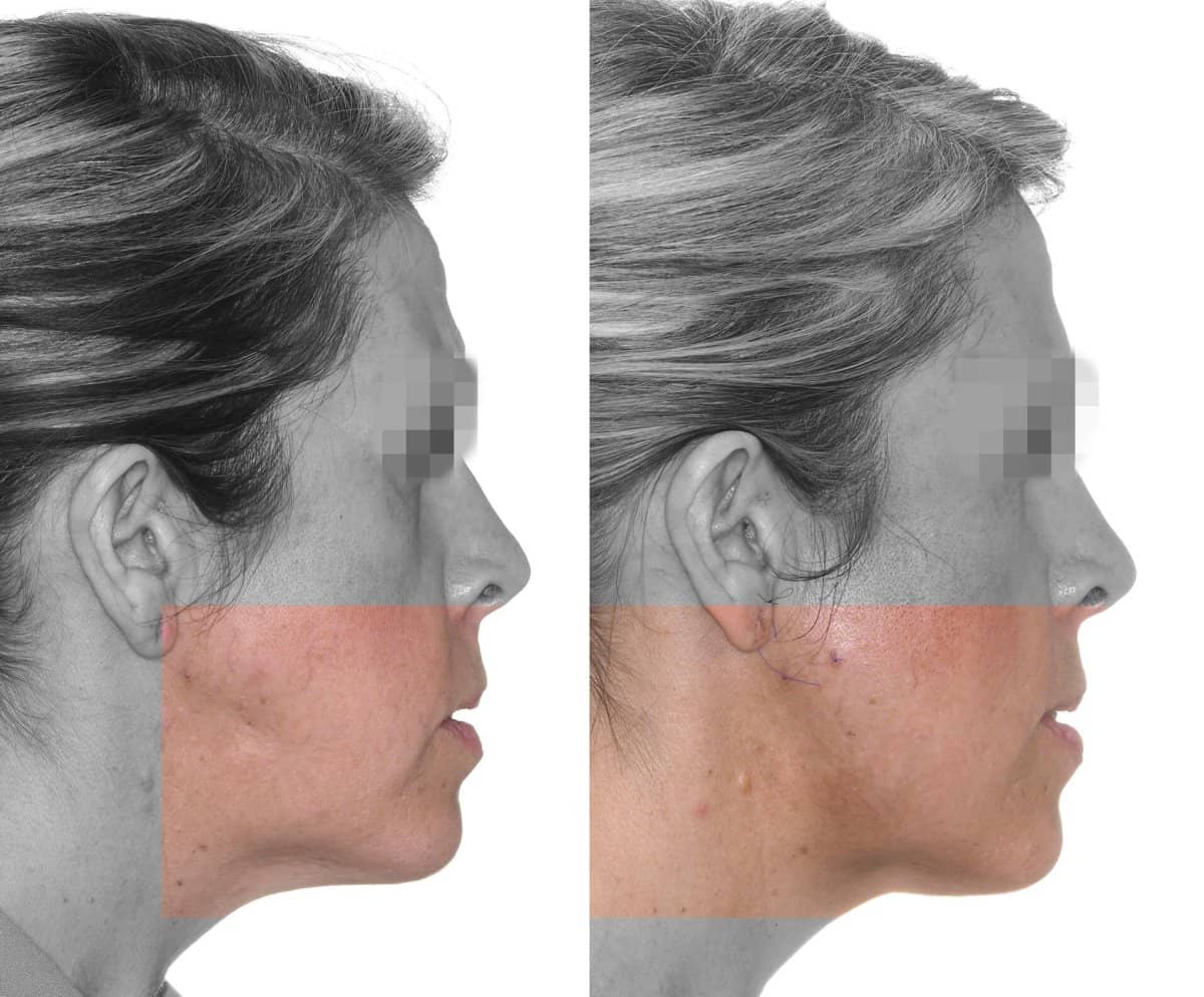Case 16096 - chin implant