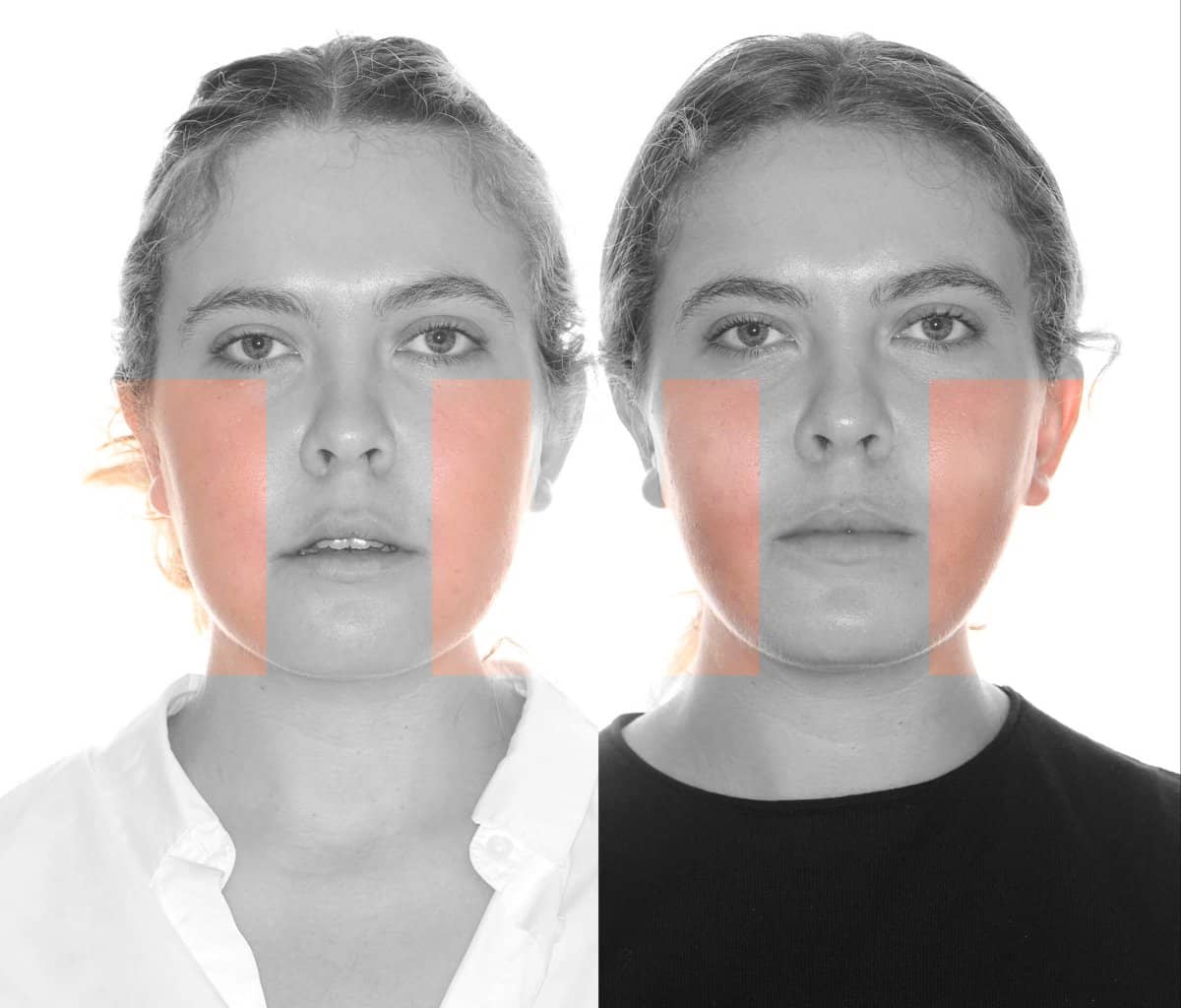 Case 16097 - buccal fat extraction