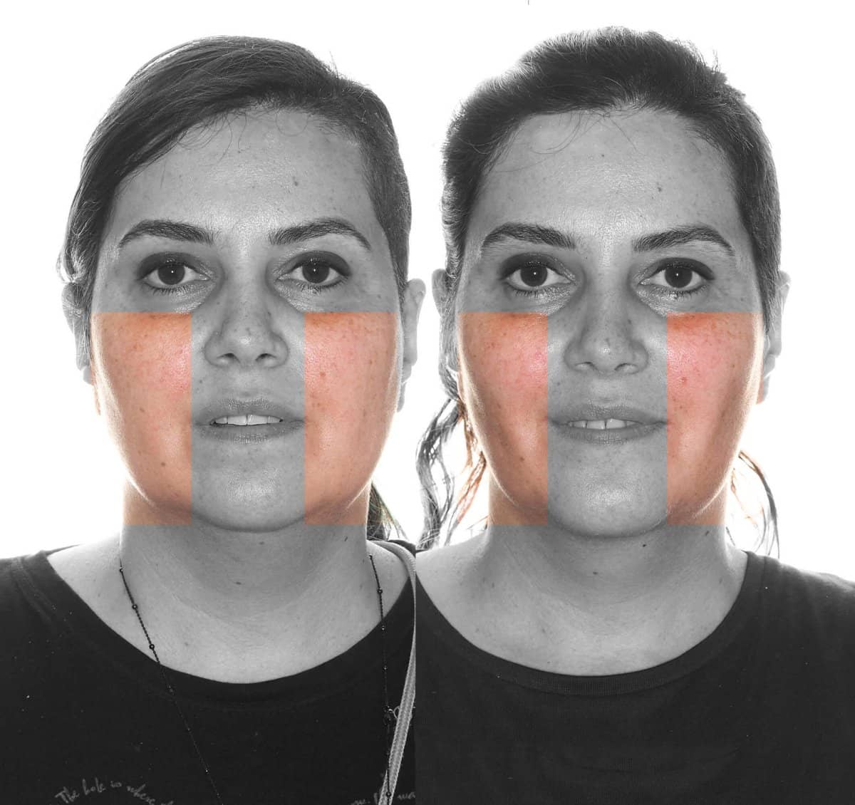 Case 16101 - buccal fat extraction