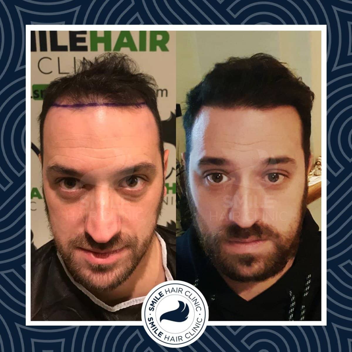 Case 16137 - DHI hair transplant