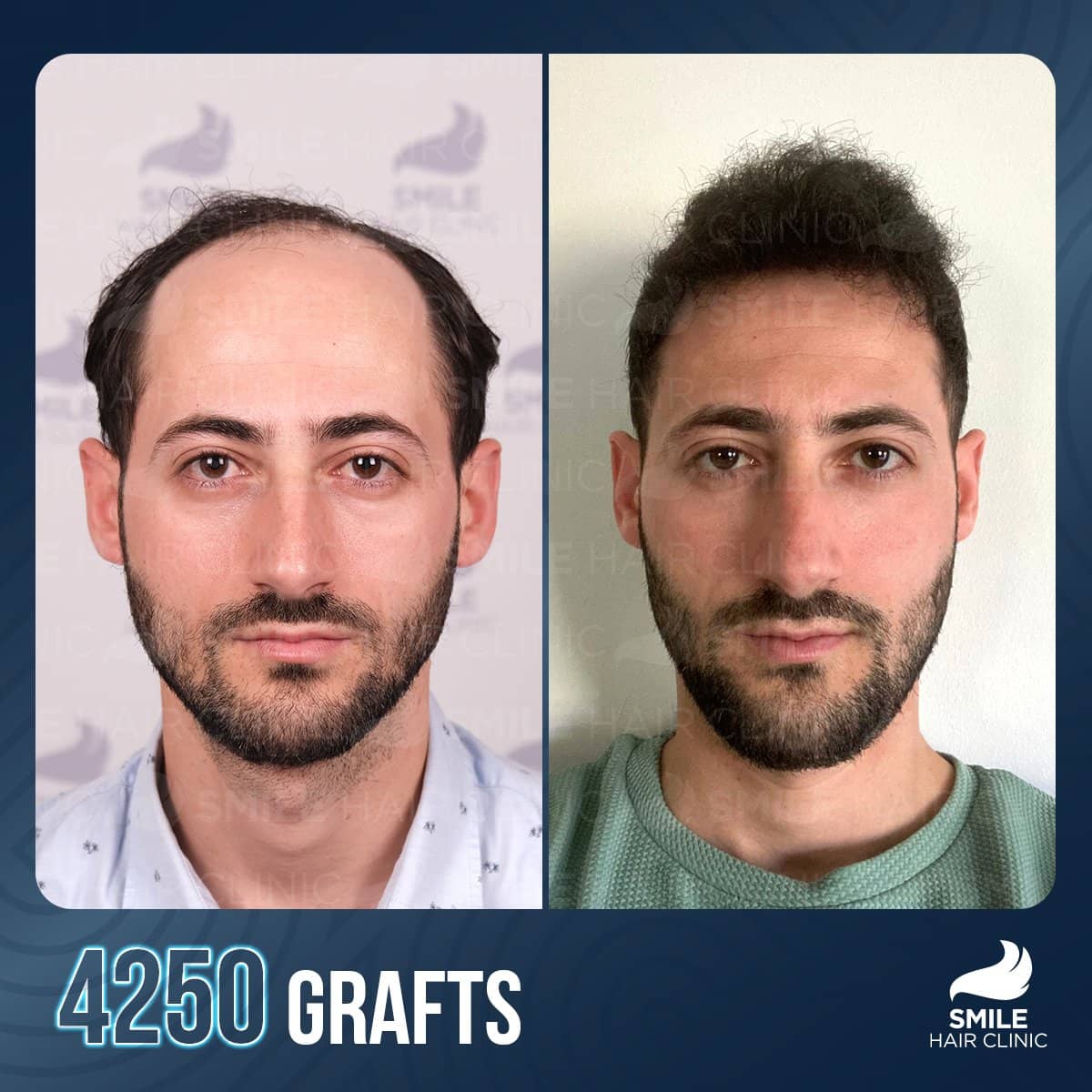 Case 16139 - FUE hair transplant