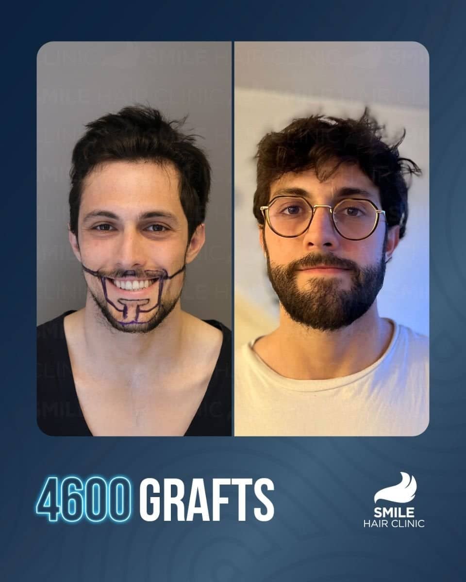Case 16142 - beard transplant