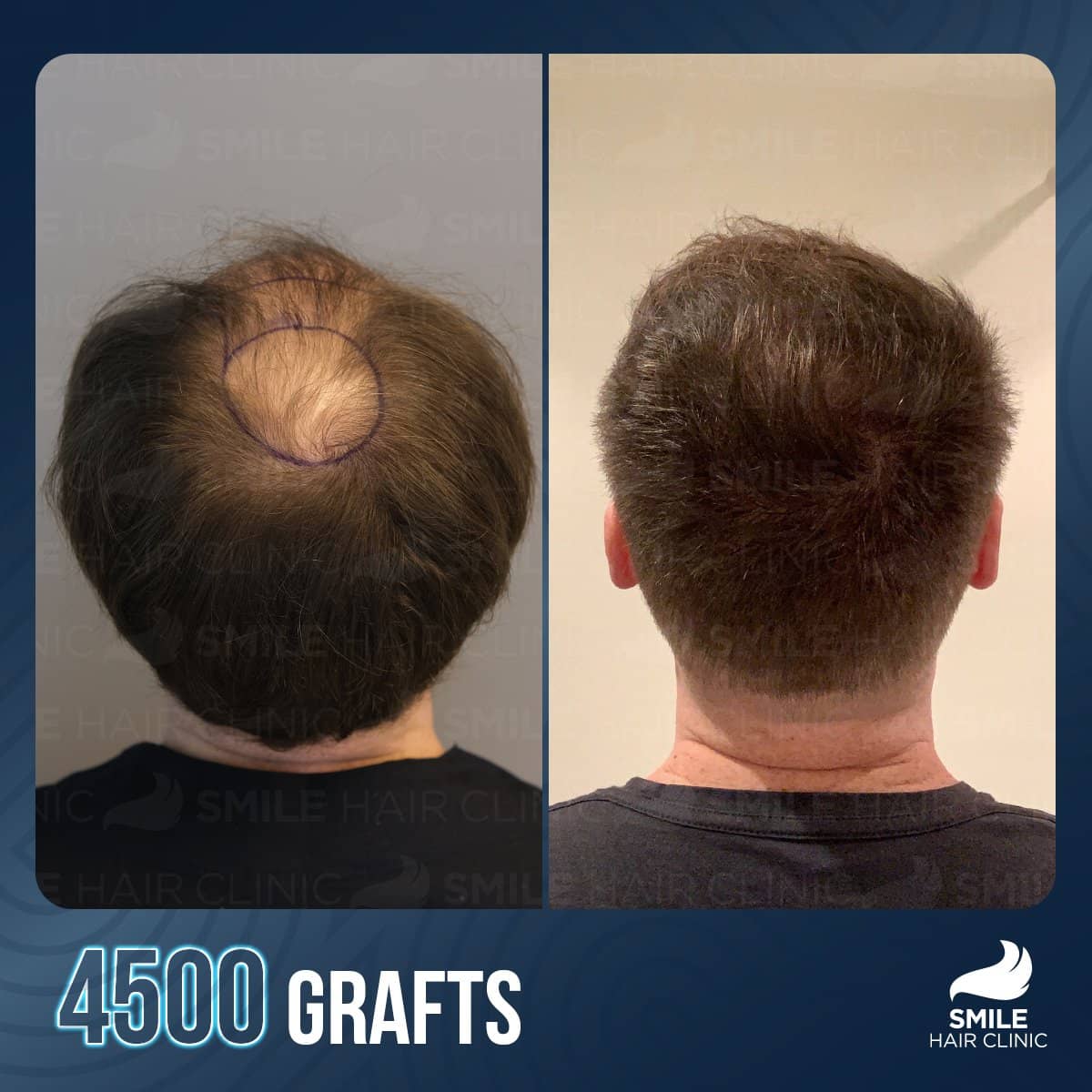 Case 16145 - before and after
