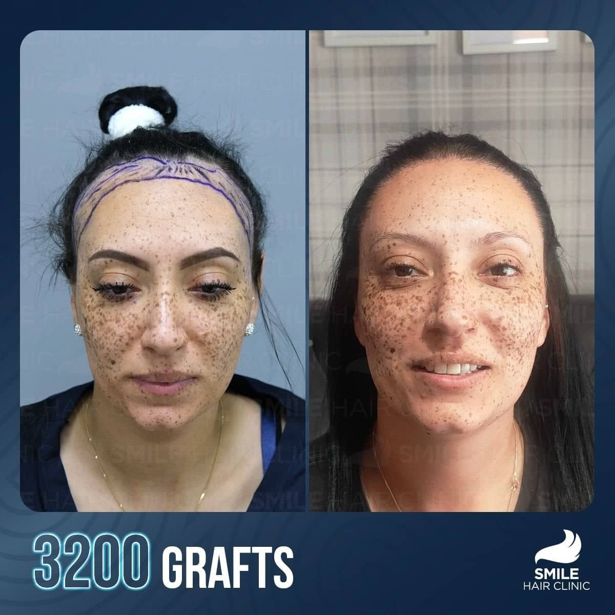 Case 16148 - result, 3200 grafts