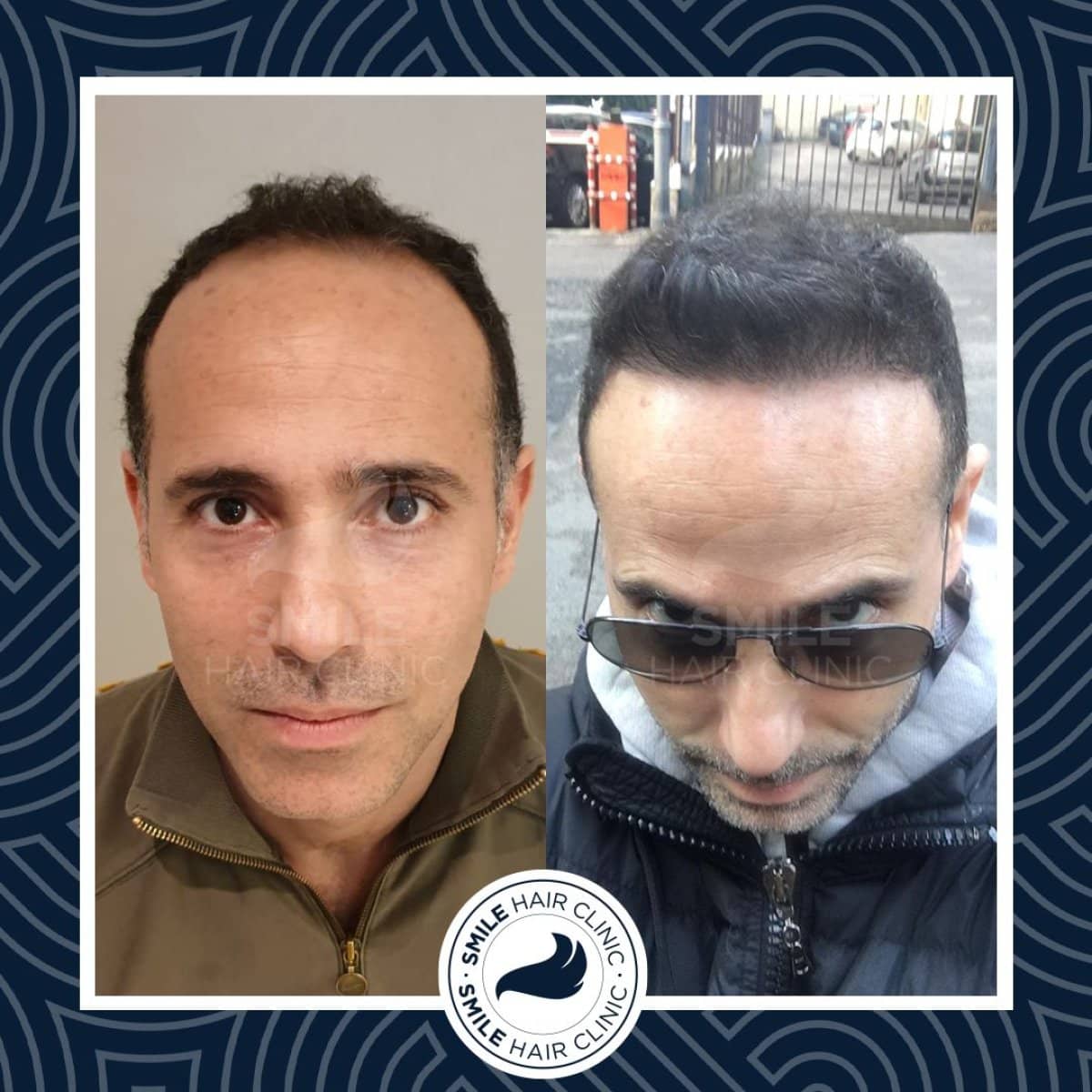 Case 16149 - DHI hair transplant