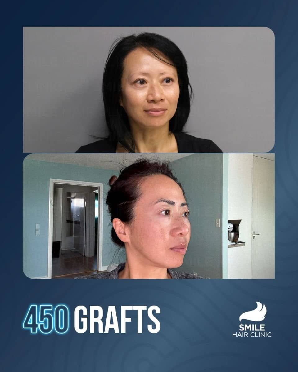 Case 16150 - eyebrow transplant
