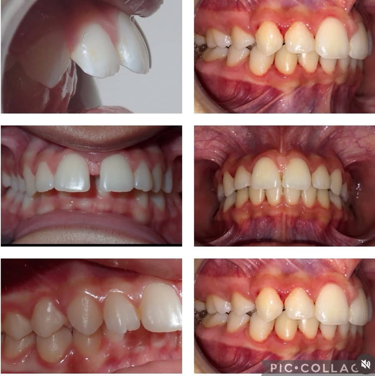 Case 16153 - braces