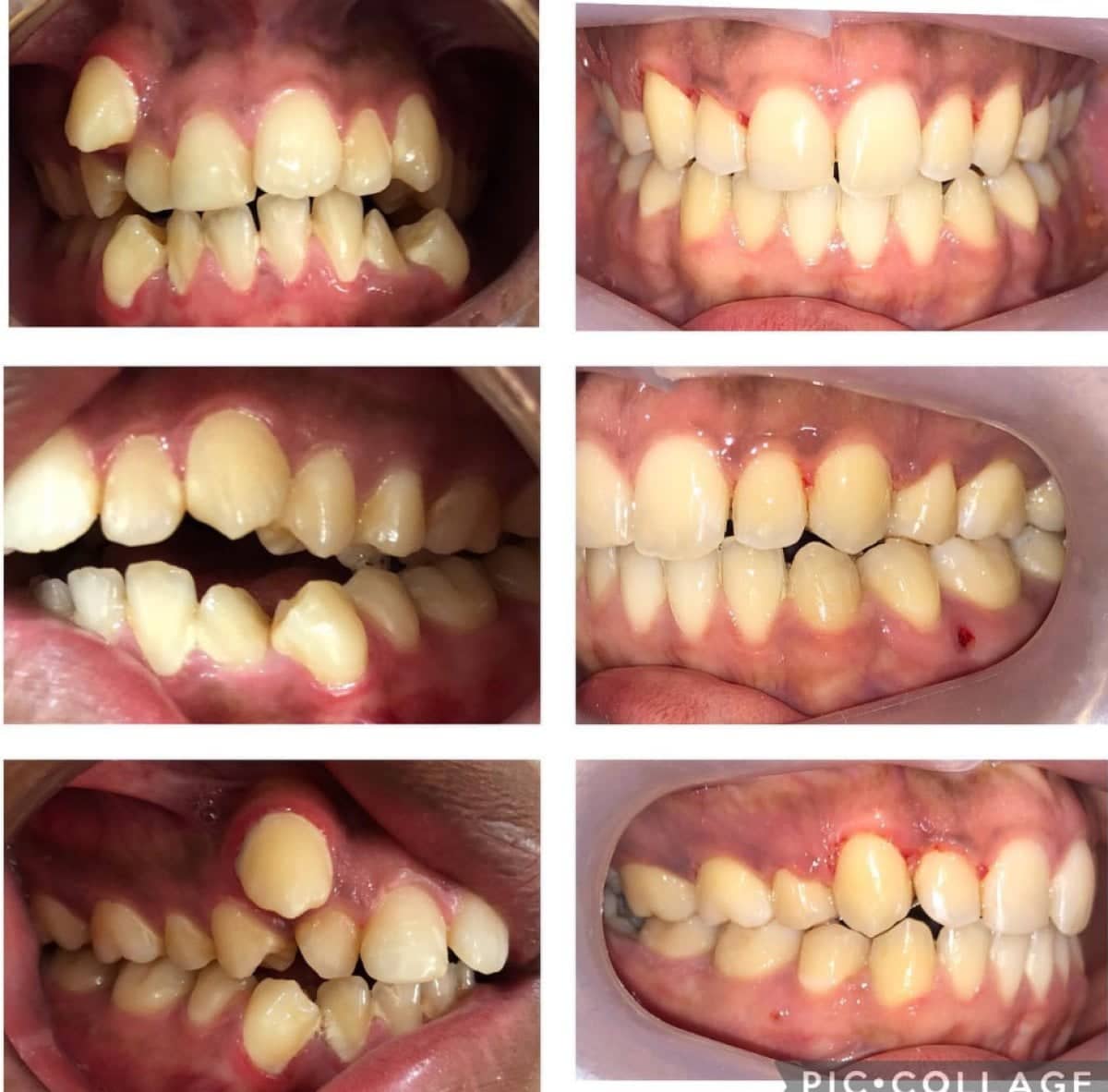 Case 16154 - braces