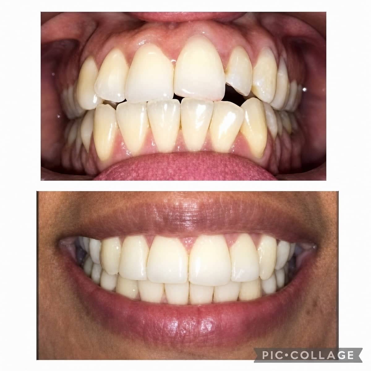 Case 16158 - braces