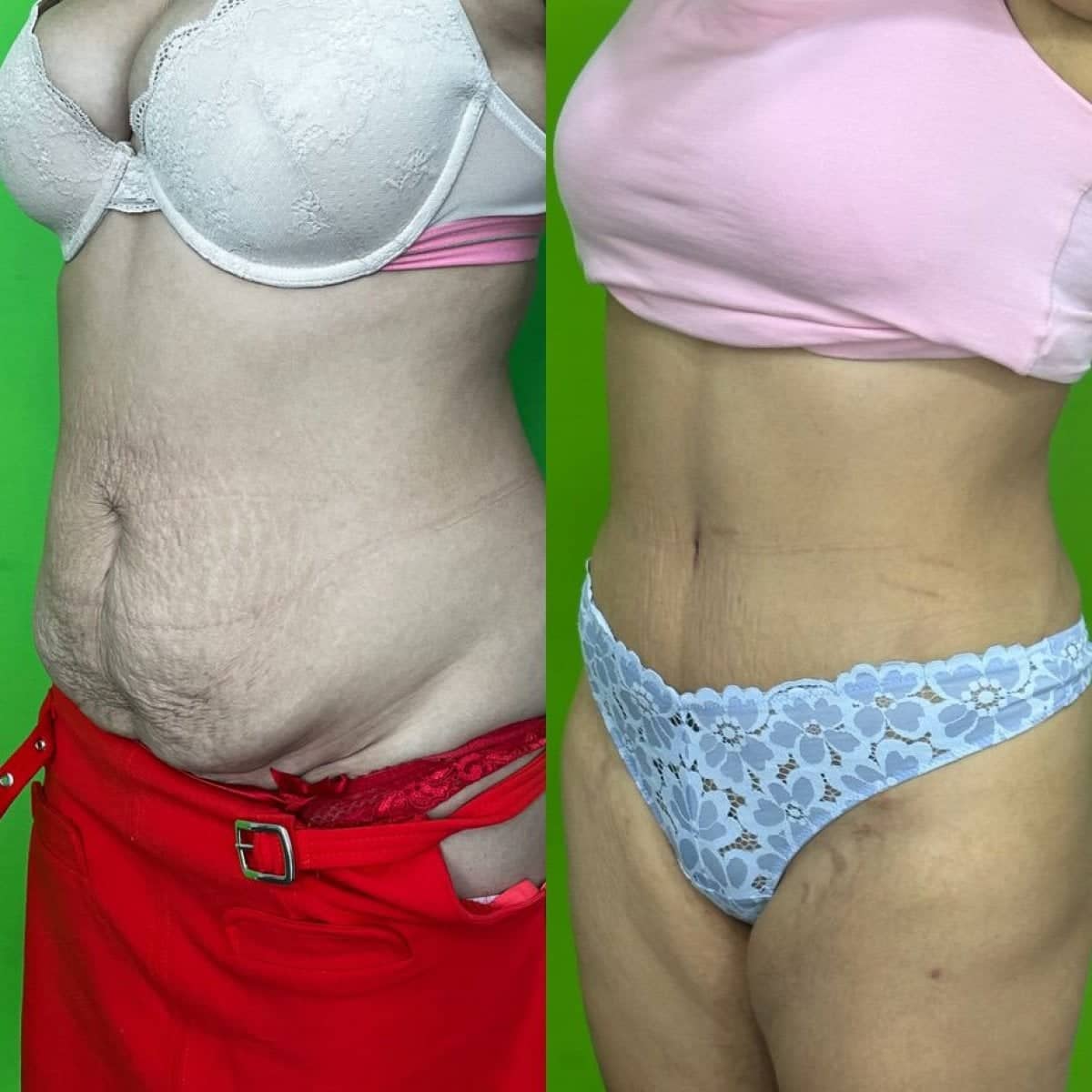 Case 16162 - liposuction