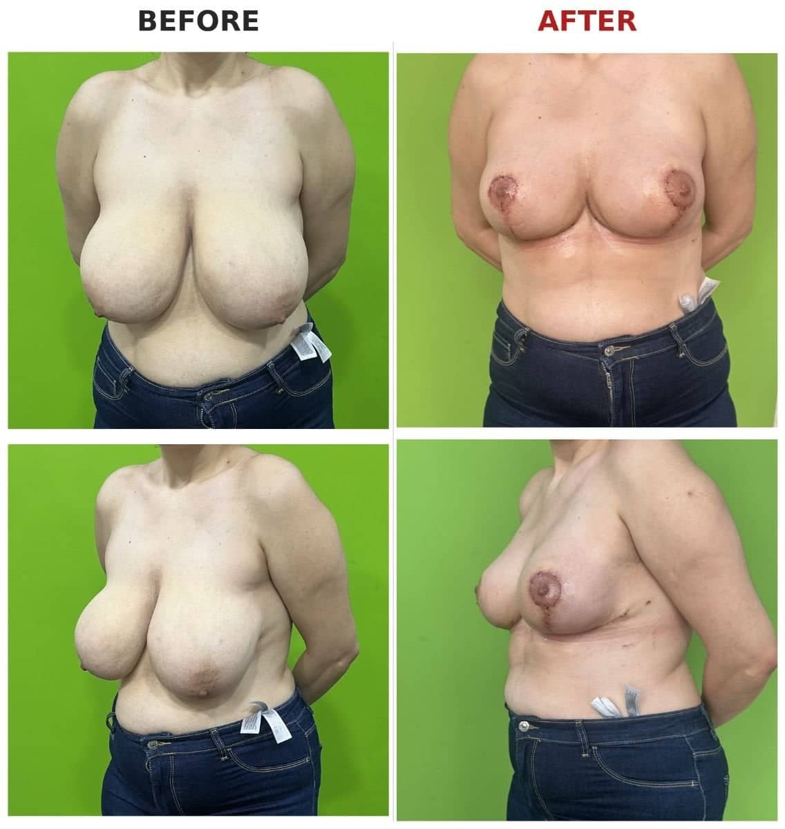Case 16163 - breast reduction