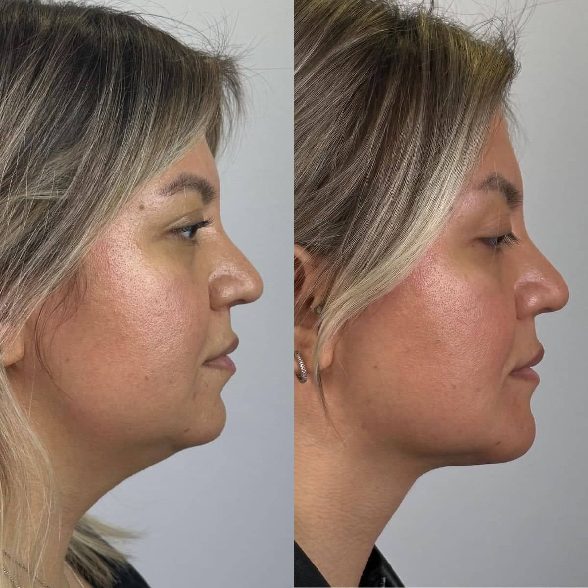 Case 16164 - chin implant