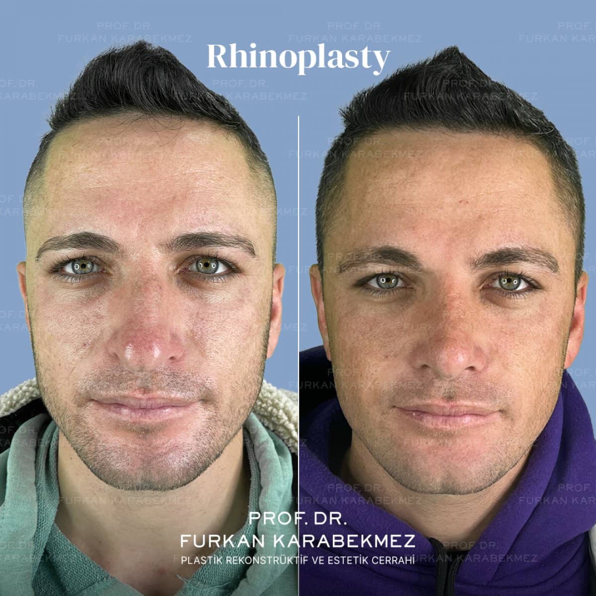 Case 16165 - rhinoplasty