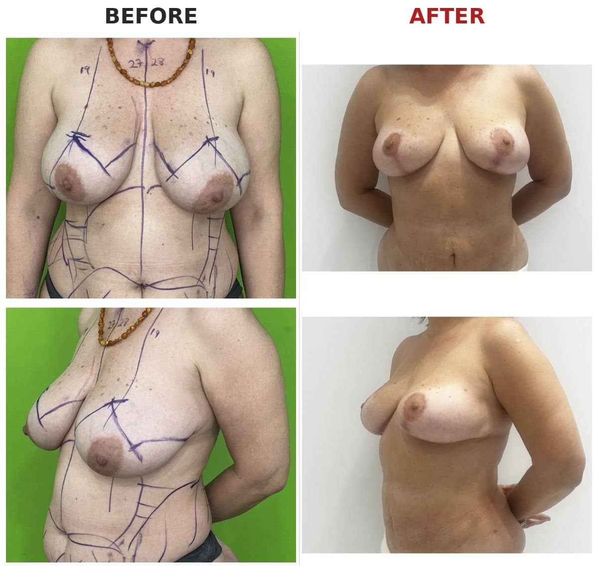 Case 16166 - liposuction and breast lift