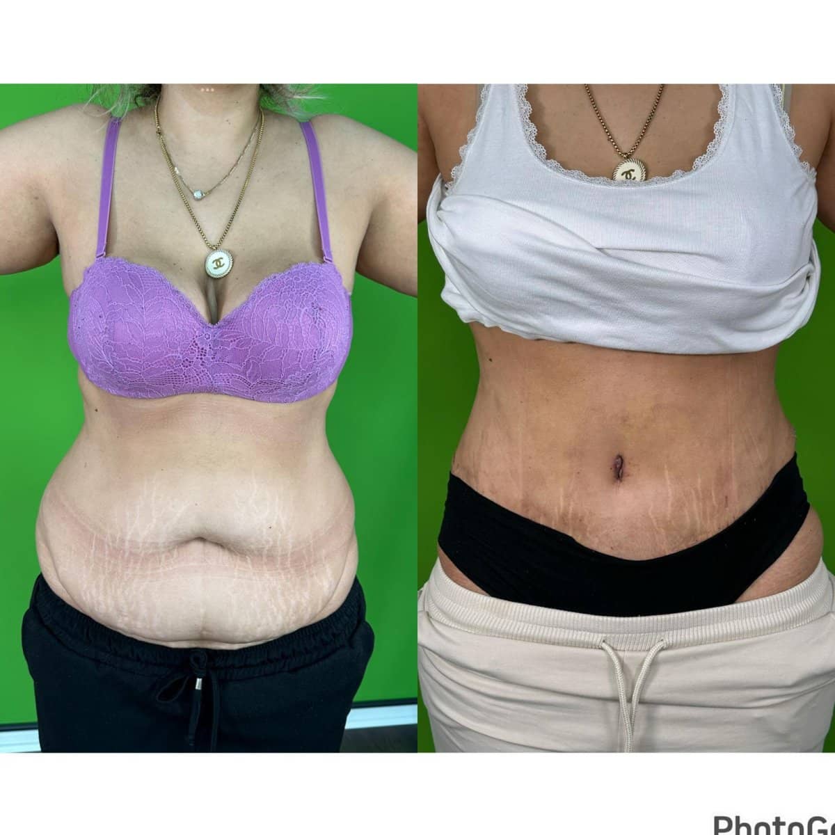 Case 16168 - tummy tuck