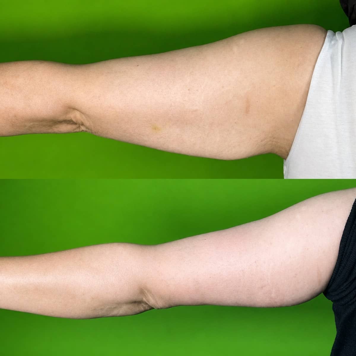 Case 16169 - arm liposuction