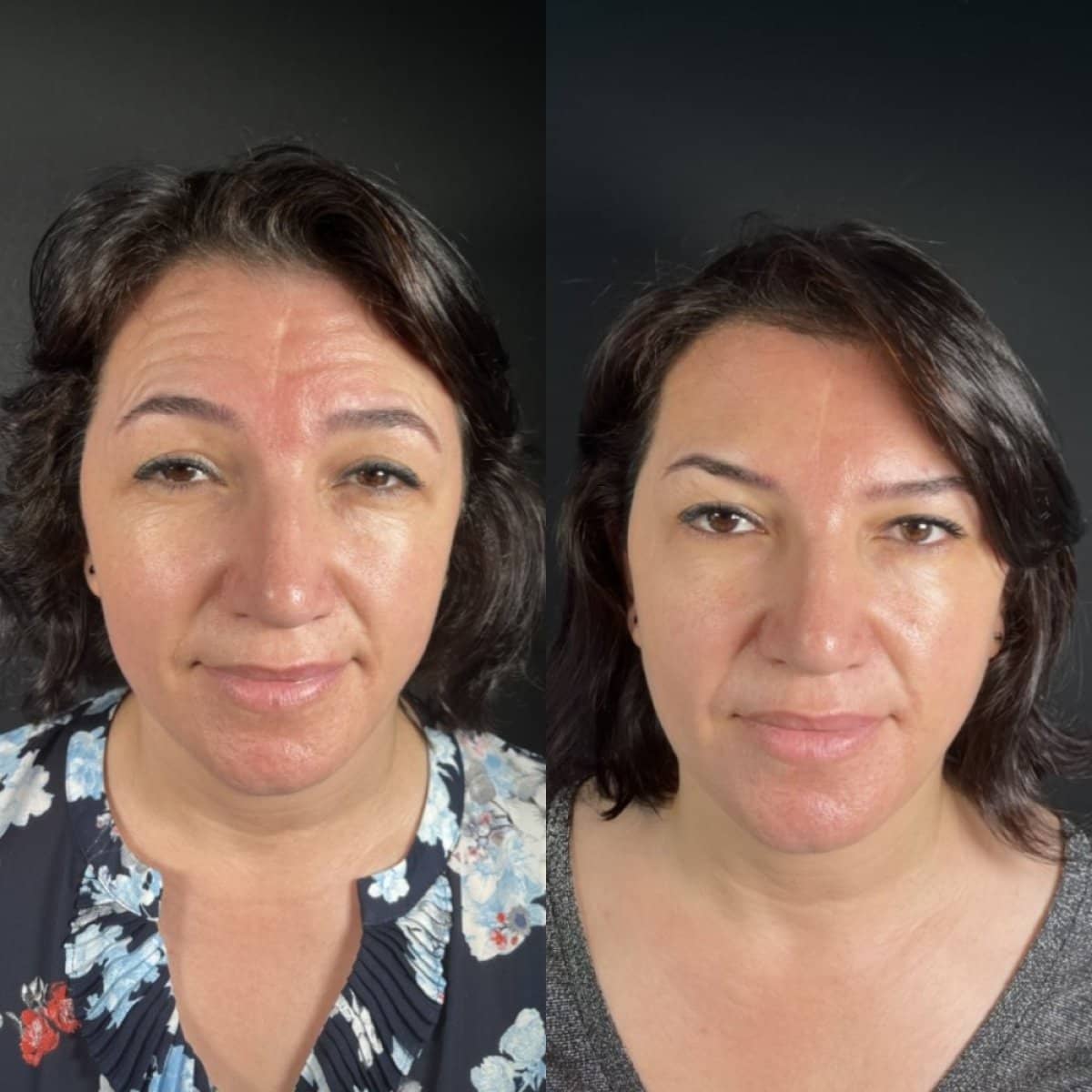 Case 16170 - Botox injections